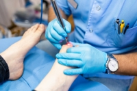 Laser Treatments for Toenail Fungus