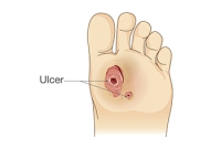 Facts and Care Guidelines Regarding Diabetic Foot Ulcers