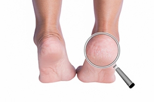 Keeping Heels Smooth and Preventing Cracks
