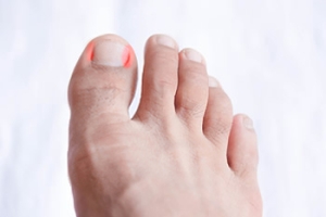 Cellulitis and Your Toenails