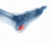 Causes and Risk Factors for Heel Spurs