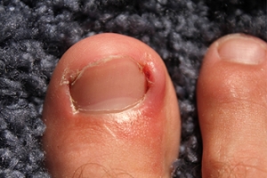 Pain From Ingrown Toenails