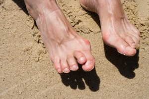 When Toes Cross or Overlap in Adults and Infants